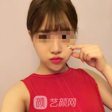 北京金燕子馬鐵安給我做的玻尿酸豐唇~